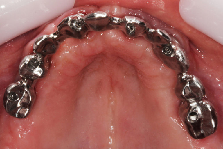 Estrutura interna que recebera a aplicação da cerâmica mimetizando os dentes