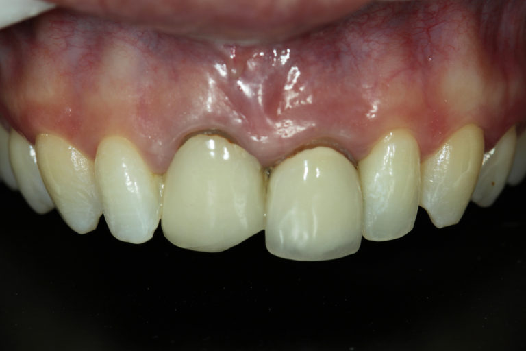 Caso inicial, onde a paciente apresente duas próteses antigas nos incisivos centrais