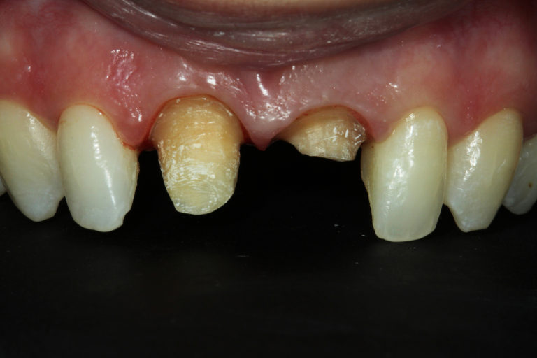 Remanescente dentaria após a remoção das próteses antigas