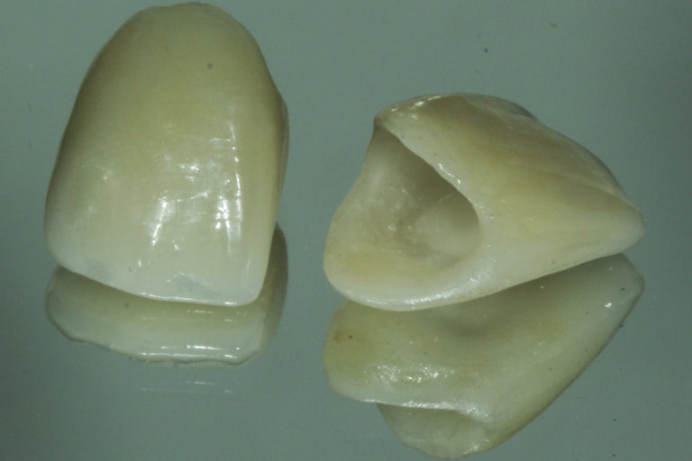 Coroas em dissilicato de lítio - porcelana