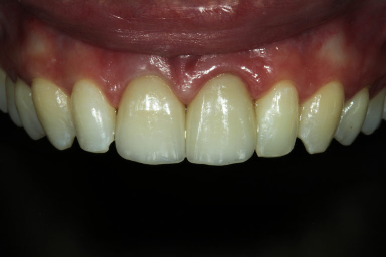 Coroas unitárias cimentadas