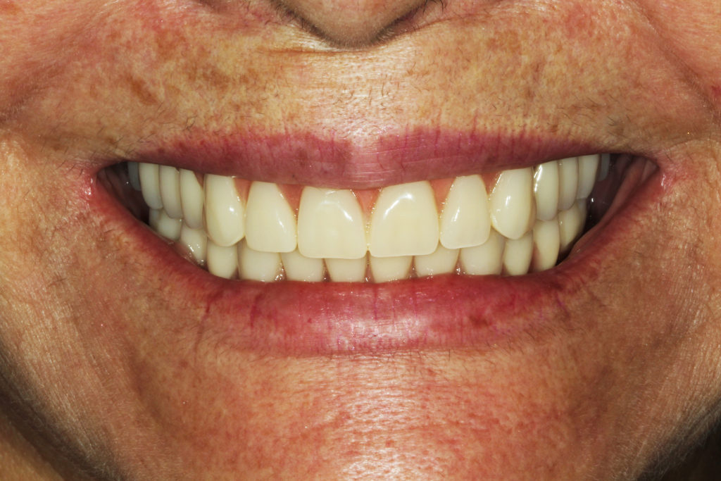 Prótese Total Superior Instalada