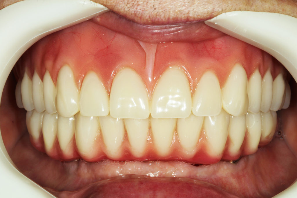 Prótese Total Superior e Prótese Protocolo Inferior