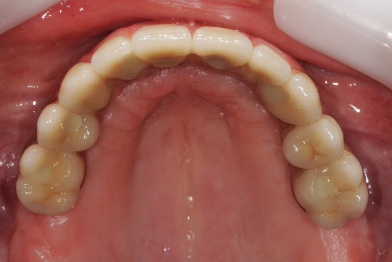Prótese protocolo superior, após aplicação da cerâmica