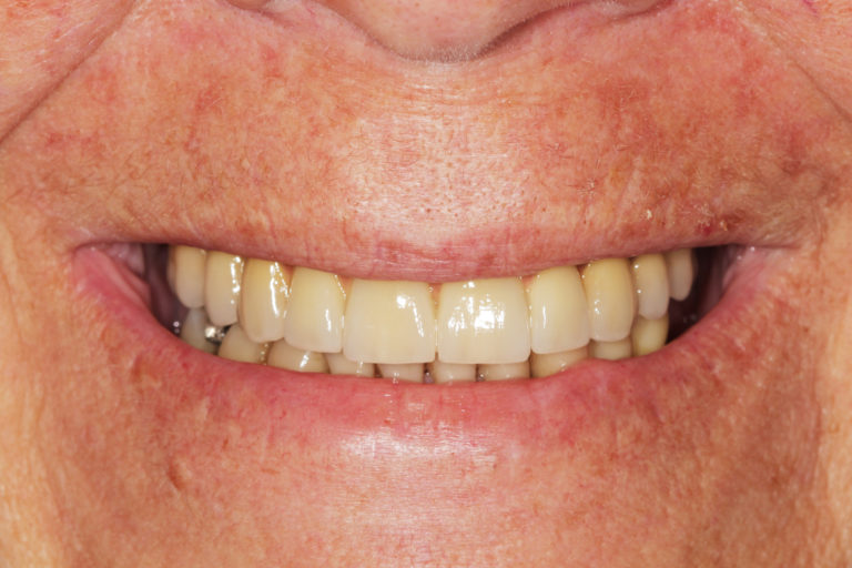 Prótese protocolo superior em cerâmica instalada